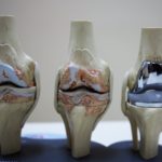 operasi penggantian sendi lutut